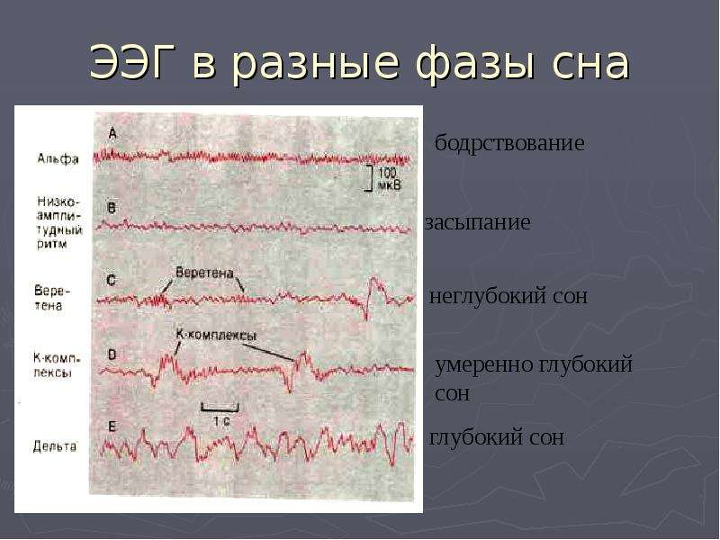 Нарисовать схему стадий сна по данным ээг