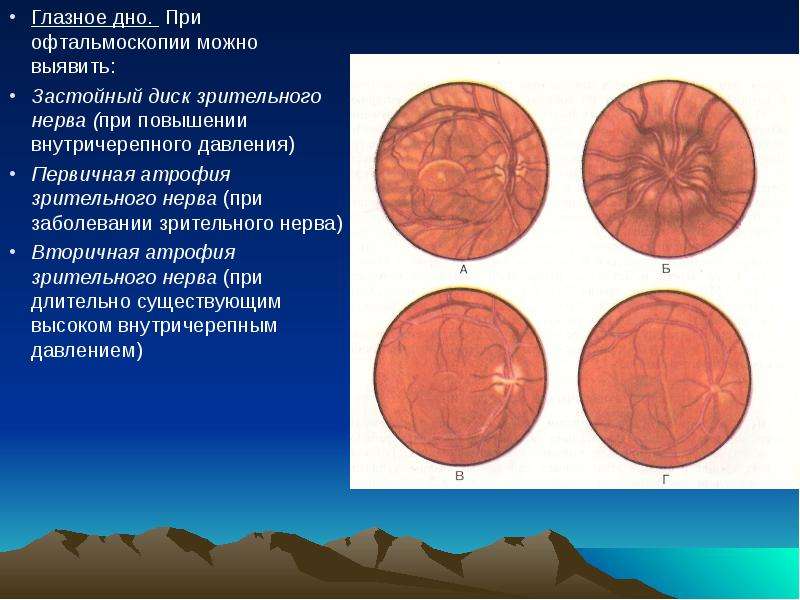 Застойный диск зрительного нерва презентация