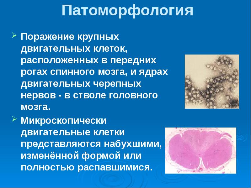 Полиомиелит патологическая анатомия презентация