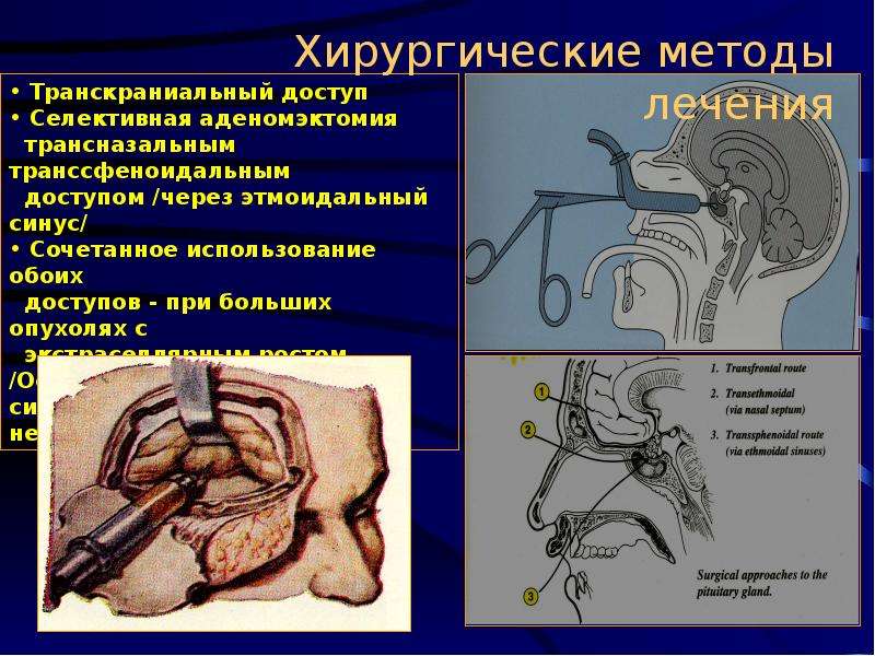 Методы хирургии. Трансназальная аденомэктомия. Транссфеноидальным доступом. Транссфеноидальная аденомэктомия ход операции. Транскраниальная аденомэктомия.