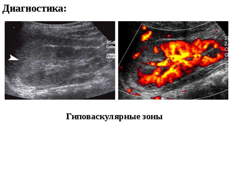 Пиелонефрит узи картина