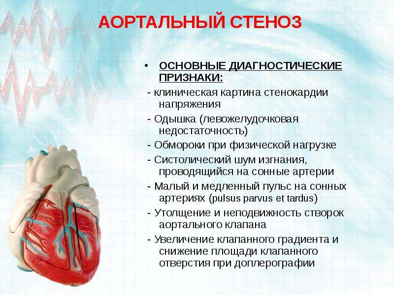 Аортальные пороки сердца презентация