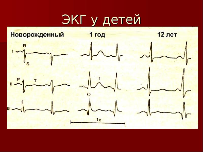 Экг детям картинки