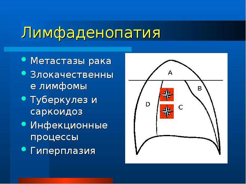 Опухоли средостения презентация