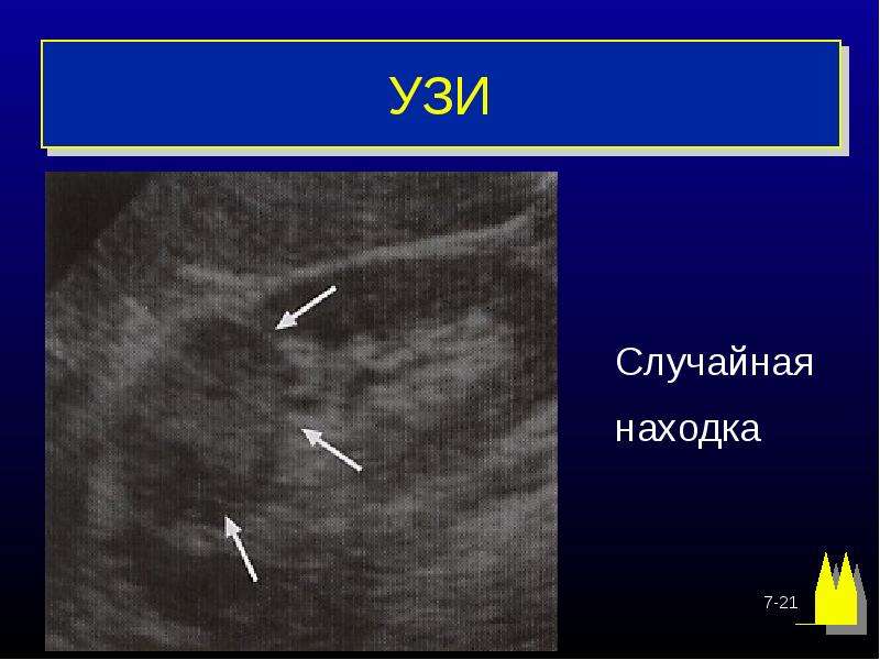 Опухоли почек презентация