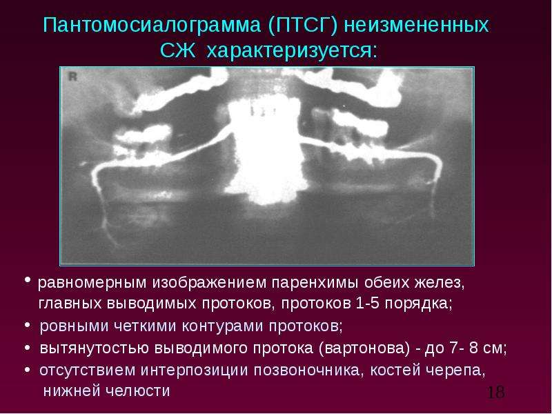 Лучевая диагностика заболеваний слюнных желез презентация