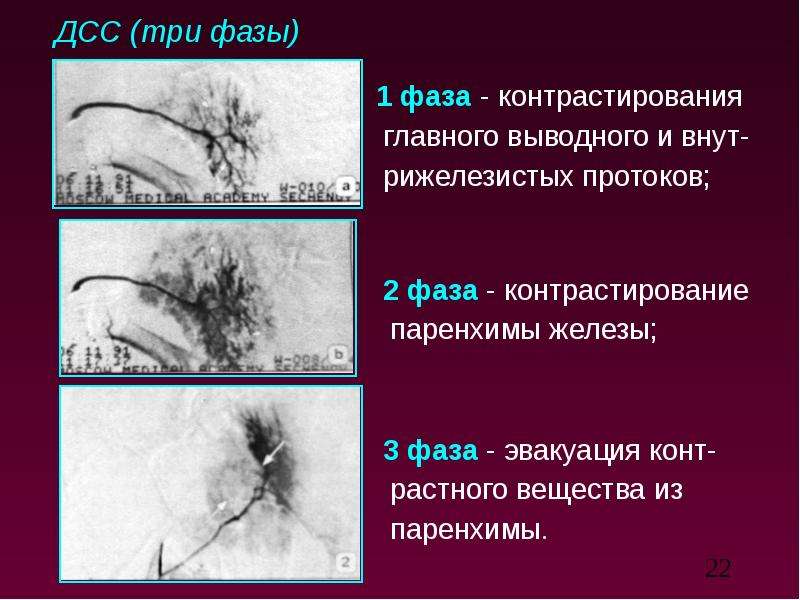 Лучевая диагностика заболеваний слюнных желез презентация