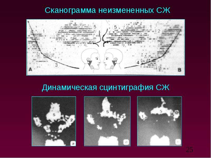 Лучевая диагностика заболеваний слюнных желез презентация