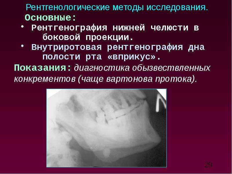 Лучевая диагностика заболеваний слюнных желез презентация