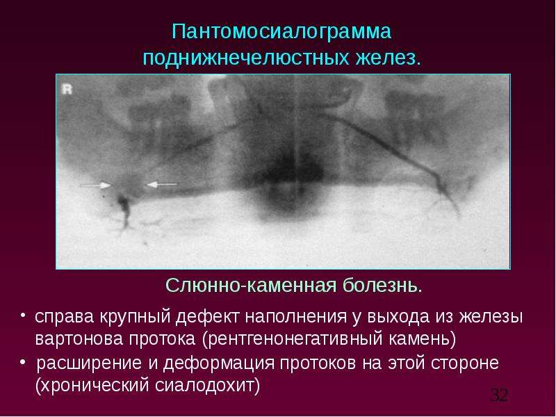 Лучевая терапия при раке слюнных желез