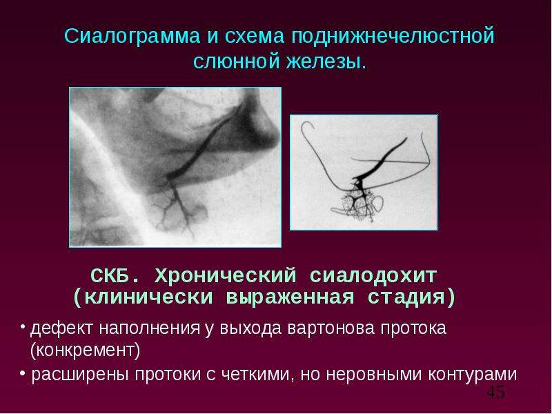 Лучевая диагностика заболеваний слюнных желез презентация