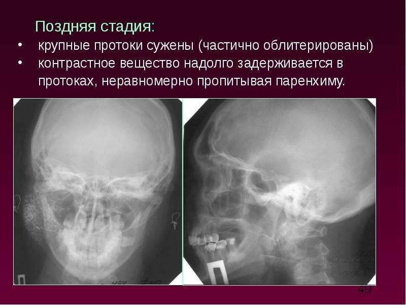 Лучевая терапия при раке слюнных желез