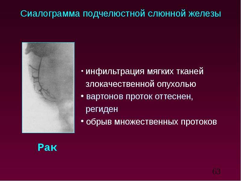 Лучевая диагностика заболеваний слюнных желез презентация