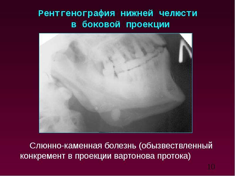 Лучевая диагностика заболеваний слюнных желез презентация