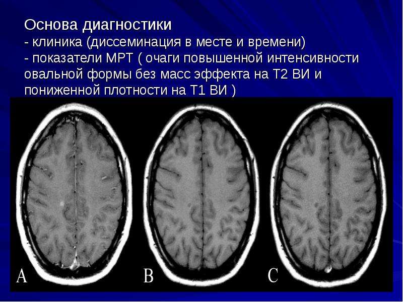 Очаги повышенной интенсивности