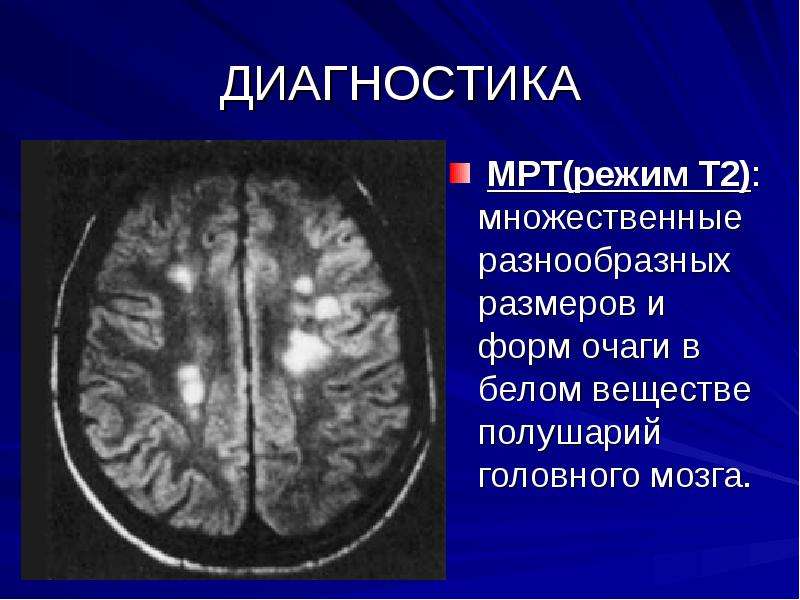 Картина очаговых изменений вещества головного мозга сосудистого характера