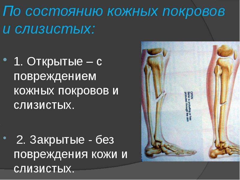 Готовая презентации на тему переломы костей