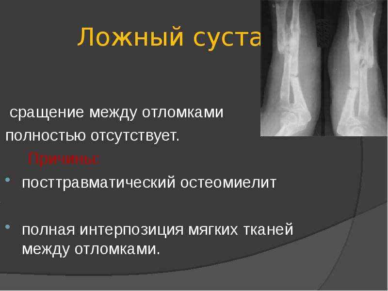 Презентация переломы трубчатых костей