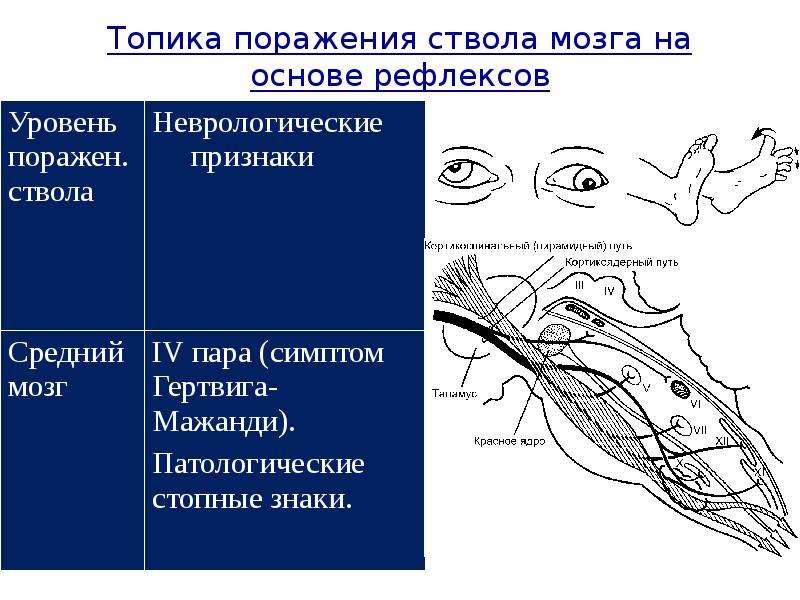 Поражение ствола мозга симптомы. Топика поражения это. Топика поражения лицее. Мезенцефальный, понтинный и бульбарный уровни поражения ствола.