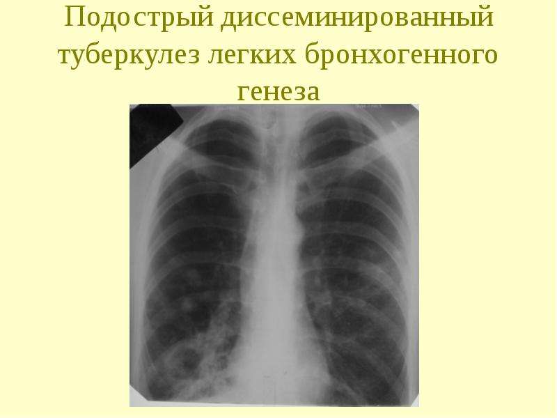Формы диссеминированного туберкулеза. Подострый диссеминированный туберкулез рентген. Острый диссеминированный туберкулез рентген. Острый диссеминированный туберкулез легких рентген. Бронхогенный диссеминированный туберкулез.