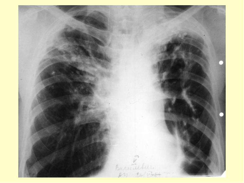 Рентгенологическая картина при милиарном туберкулезе