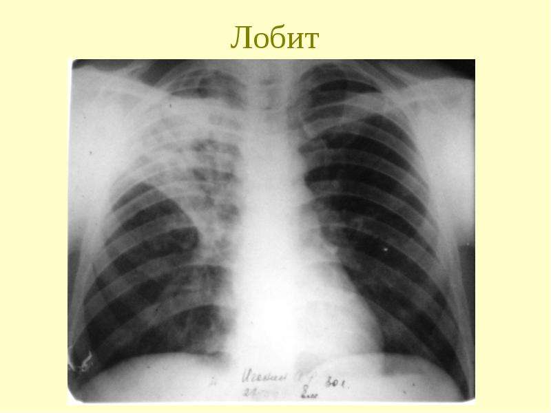 Инфильтративного в фазе распада. Инфильтративный туберкулез Лобит рентген. Инфильтративный туберкулез в фазе распада рентген. Инфильтративный туберкулез с распадом рентген. Инфильтративный туберкулез в фазе распада снимки легких.