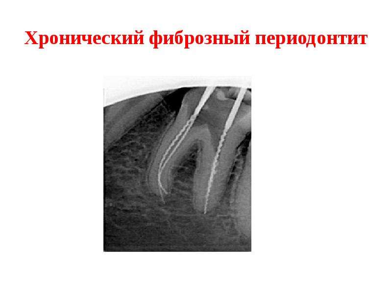 Хронический фиброзный периодонтит лечение. Хронический апикальный периодонтит рентген. Гранулематозный периодонтит на рентгенограмме. Хронический апикальный гранулирующий периодонтит. Хронический фиброзный верхушечный периодонтит..