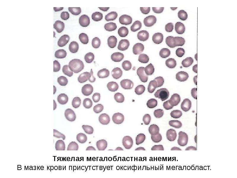 Картина крови при мегалобластной анемии