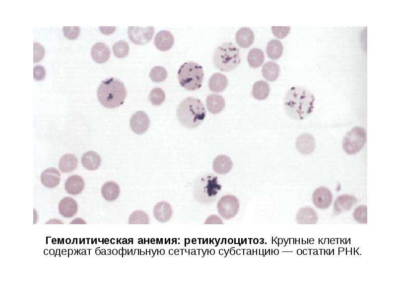 Гемолитическая анемия картина крови