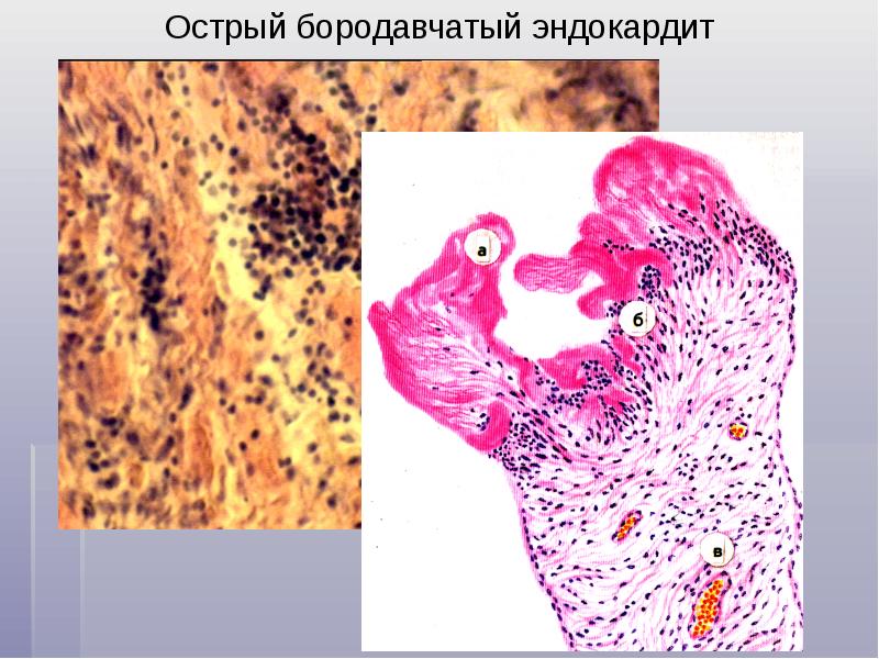 Ревматический миокардит микропрепарат рисунок