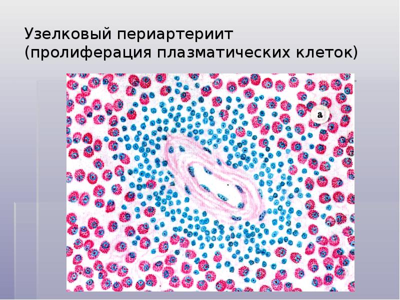 Васкулиты патанатомия презентация