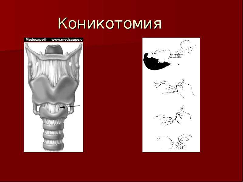 Трахеостомия техника выполнения в картинках для детей