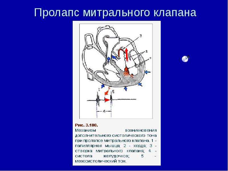 Признаки пролапса митрального клапана