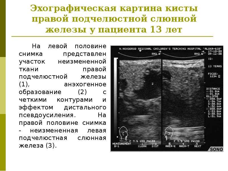 Для эхографической картины острого холецистита характерно тест ответ