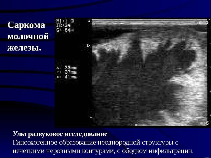 Рак молочной железы фото на снимке узи с нечеткими контурами