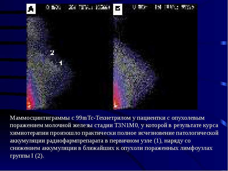 Исследование молочных желез. Сцинтимаммография молочной железы. Технетрил 99mtc. Технетрил 99mtc барий. Морфологический метод исследования молочной железы.