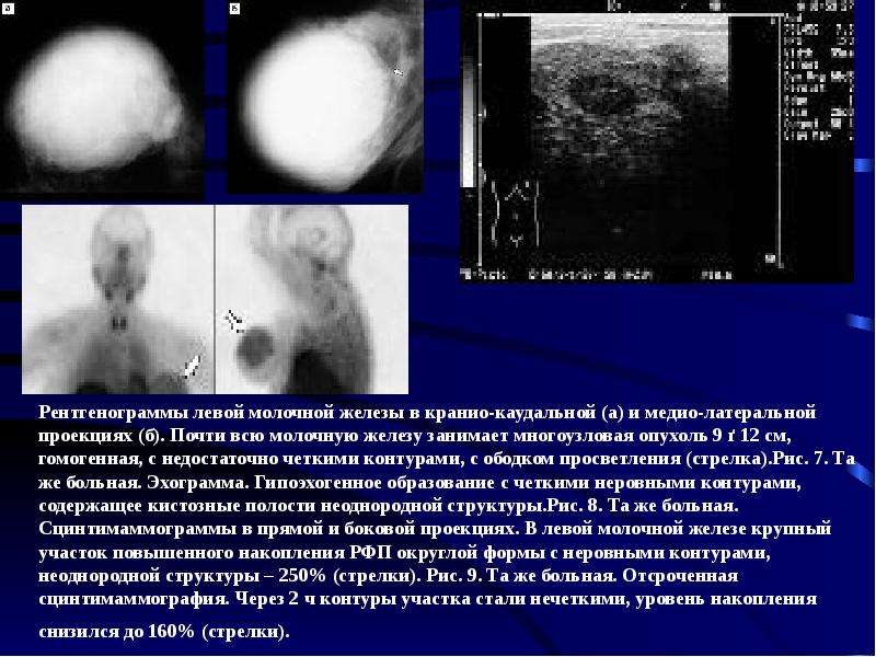 Образование молочной. Образований на молочных железах. Патологические образования в молочной железе. Образование левой молочной железы. Негомогенное образование в молочной железе что это.