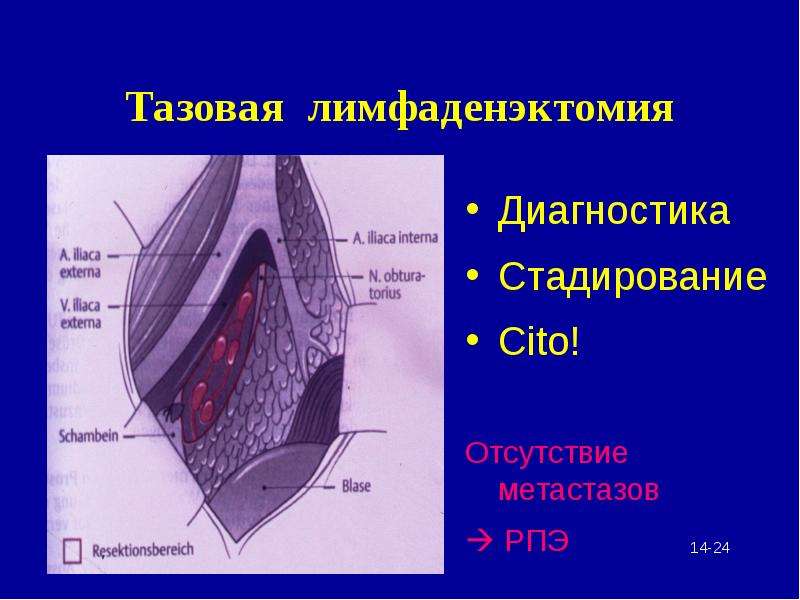 Лимфаденэктомия