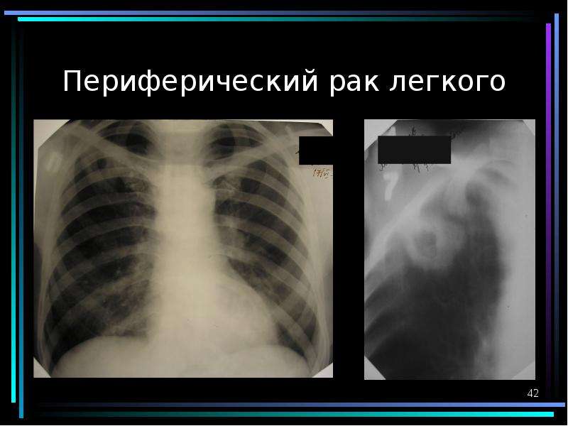 Периферический рак легкого. Периферическая опухоль легкого s1. Периферический РК легкого. Периферическое очаговое образование в легких. S。Периферический с г легкого.