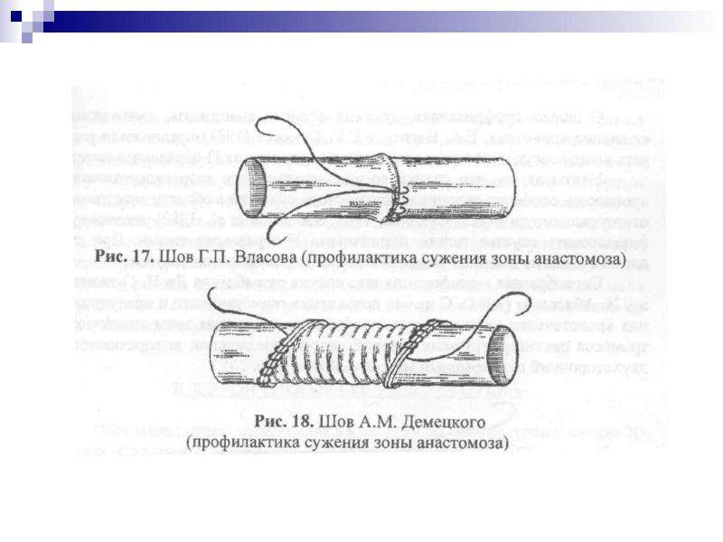 Экстравазальная компрессия артерий