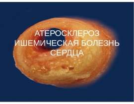 Атеросклероз