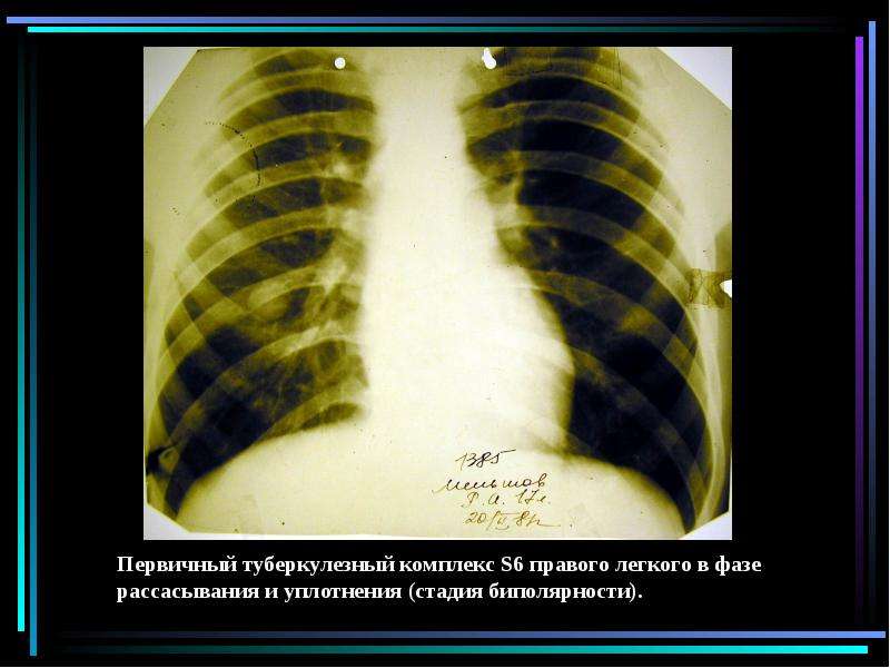 Первичный туберкулезный комплекс. Первичный туберкулезный комплекс в фазе кальцинации. Первичный туберкулезный комплекс стадия рассасывания. Первичный туберкулезный комплекс фаза рассасывания биполярности. Туберкулез в стадии уплотнения.