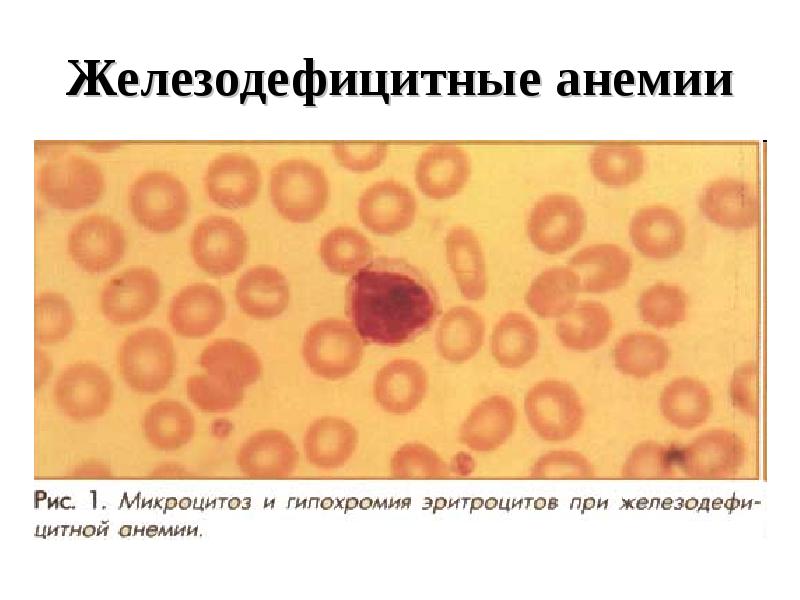 Гипохромия железодефицитная анемия