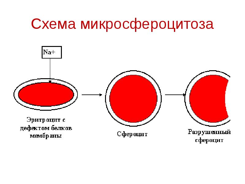 Микросфероцитоз