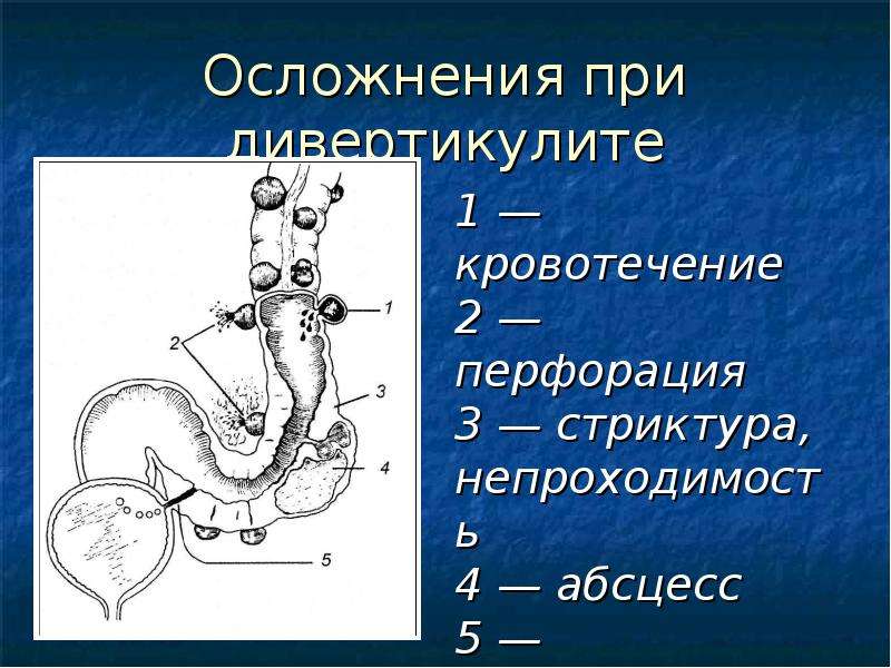 Заболевания ободочной кишки. Осложнение дивертикулеза ободочной кишки:. Операция на кишечник дивертикул. Дивертикул ободочной кишки осложнения. Дивертикулез ободочной кишки осложнения.