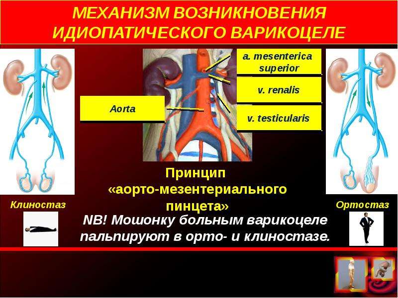 Причины возникновения и лечение варикоцеле