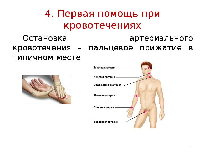 Место остановки артериального кровотечения