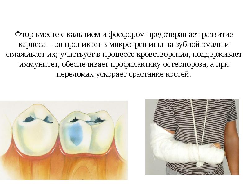 При недостаточности фтора в организме развивается. Дефицит кальция разрушение зубов. Роль фтора, кальция и фосфора в организме человека. Роль фтора в организме кальция. Кариес недостаток фтора.