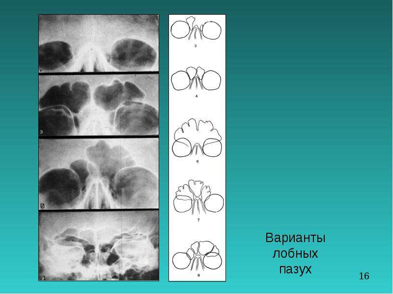 Верхняя стенка лобной пазухи участвует в формировании