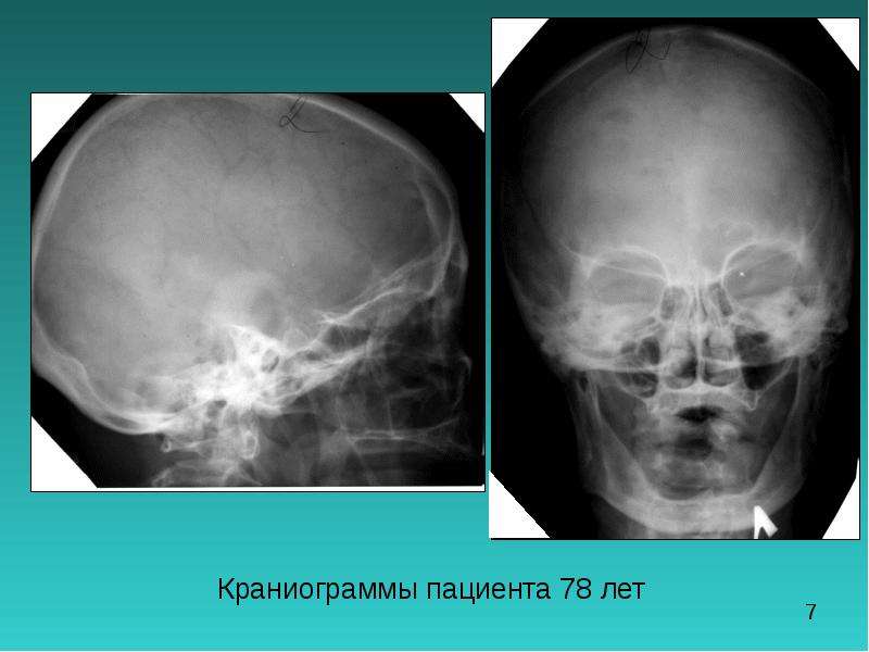 Туберкулез костей лицевого черепа презентация